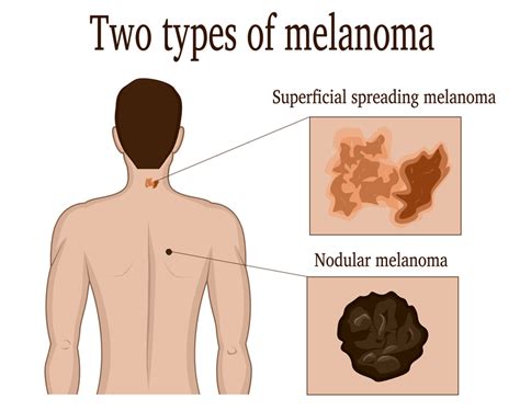 what is a nodular melanoma